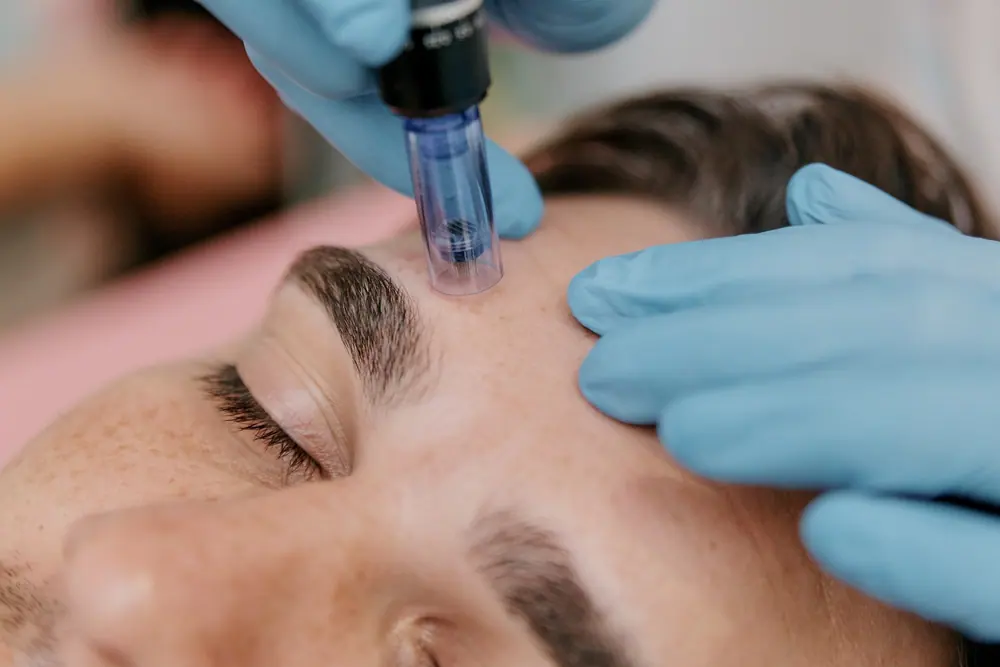Microneedling an der Stirn mit einem Microneedling-Stift
